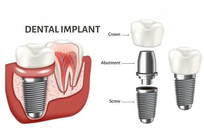 Painless Implants