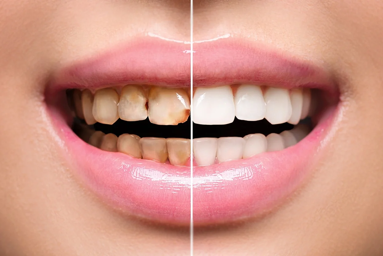 Restoration/ Fillings