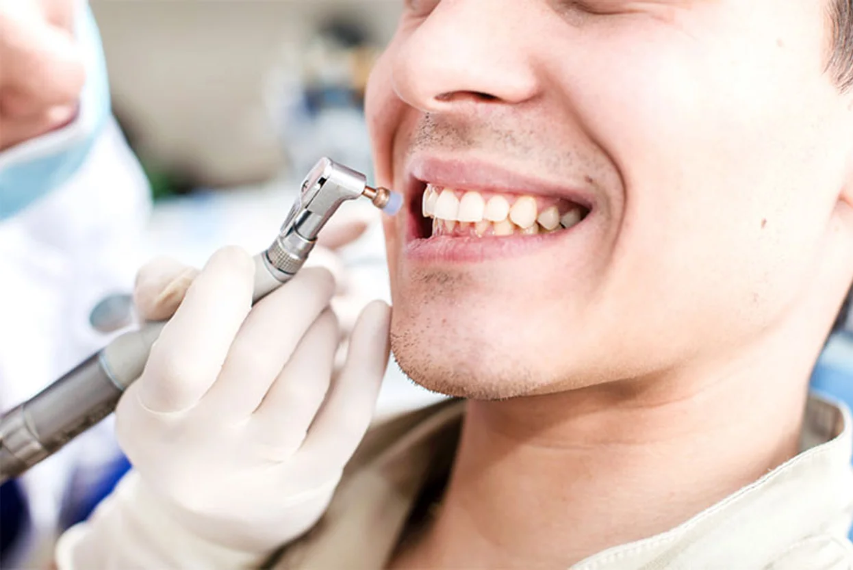 Scaling and Polishing of Teeth